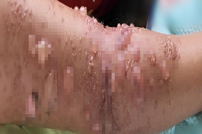 TPHCM: Hàng loạt người vào viện cầu cứu vì đi tắm biển gặp họa bỏng sứa-2