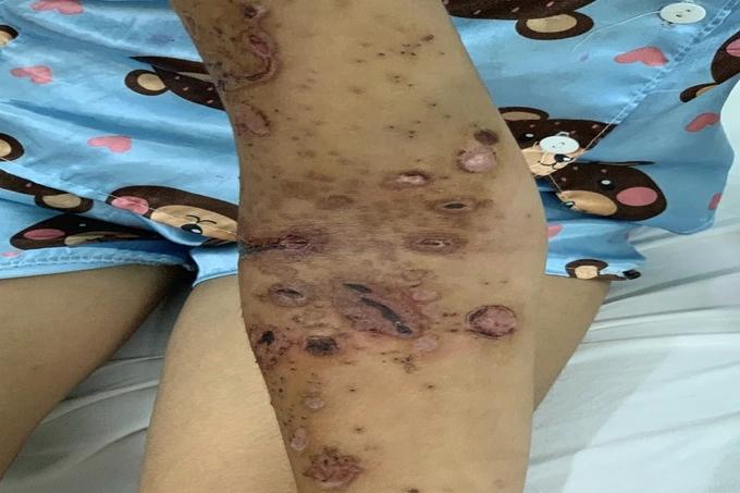 TPHCM: Hàng loạt người vào viện cầu cứu vì đi tắm biển gặp họa bỏng sứa-3