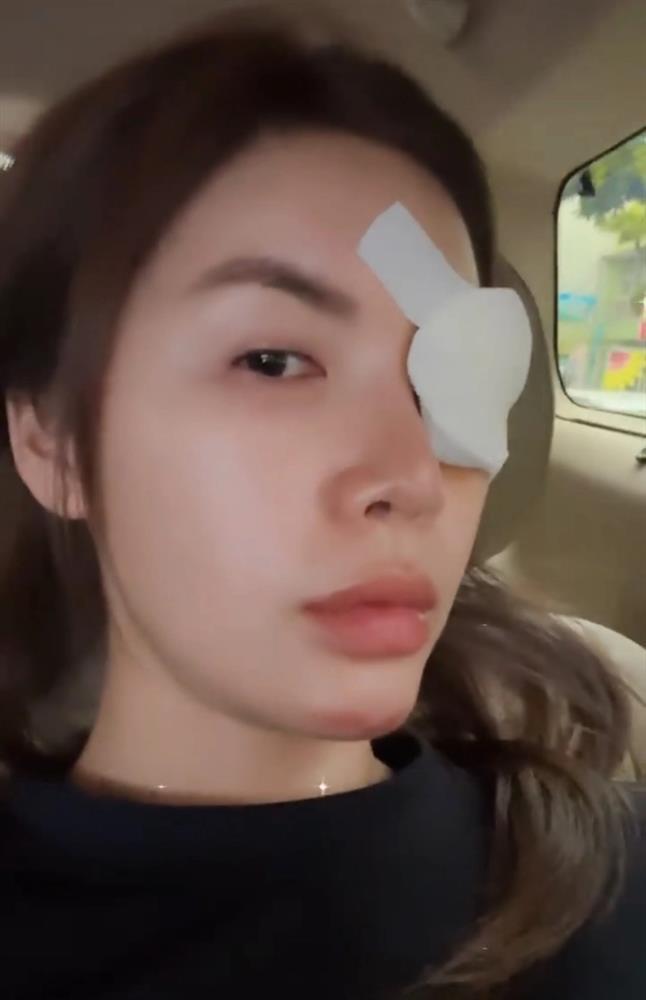 Minh Tú tiếp tục gặp vấn đề sức khỏe sau sự cố phải khâu 10 mũi ở cằm-1