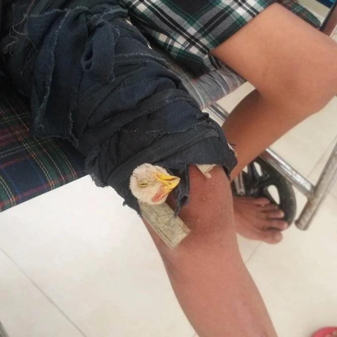 Chuyện lạ, bắt gà cắt tiết rồi buộc vào chân để chữa... gãy xương đùi-1