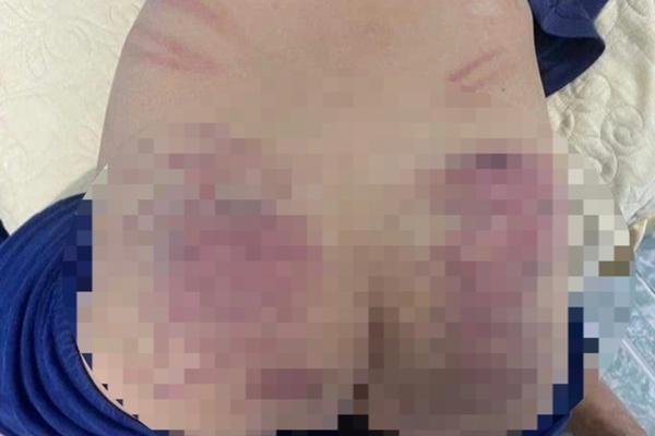 Xác minh vụ cháu bé 9 tuổi chậm phát triển nghi bị cô giáo bạo hành-1