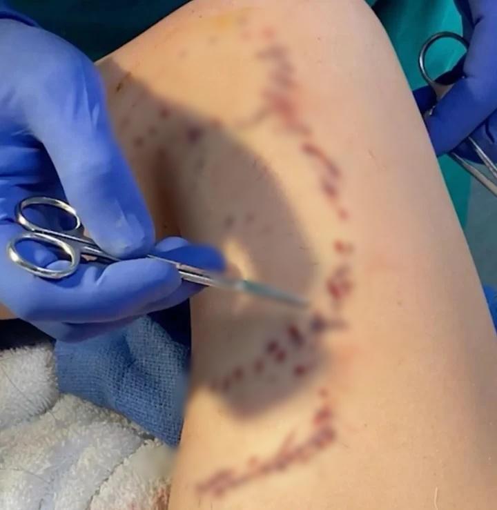 Bé gái thoát chết sau 2 lần bị cá mập tấn công với gần trăm vết cắn-2