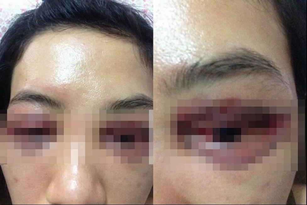 Suýt hỏng mắt sau khi làm chuột bạch cho học viên thử việc cắt mí-2