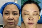 Người phụ nữ 50 tuổi ngại phẫu thuật, dùng sợi chỉ căng da, giờ phải rạch một đường lớn trên mặt, kết quả ra sao?