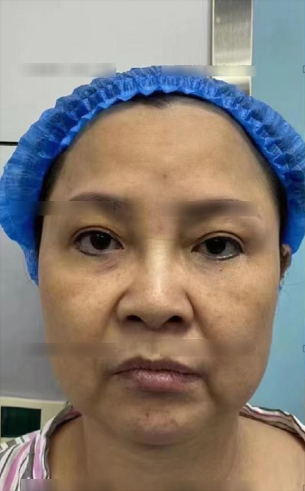 Người phụ nữ 50 tuổi ngại phẫu thuật, dùng sợi chỉ căng da, giờ phải rạch một đường lớn trên mặt, kết quả ra sao?-1