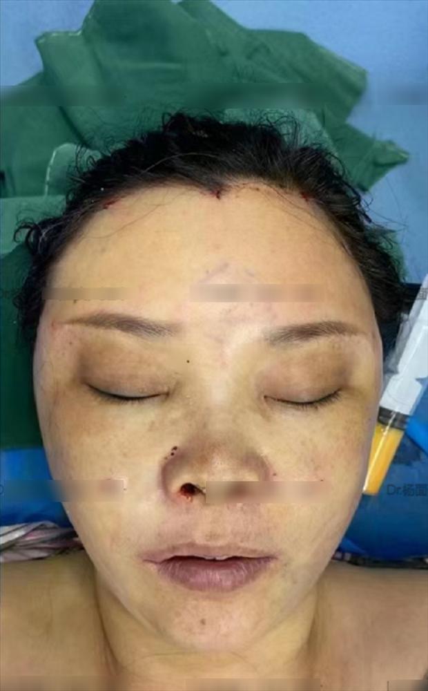 Người phụ nữ 50 tuổi ngại phẫu thuật, dùng sợi chỉ căng da, giờ phải rạch một đường lớn trên mặt, kết quả ra sao?-2