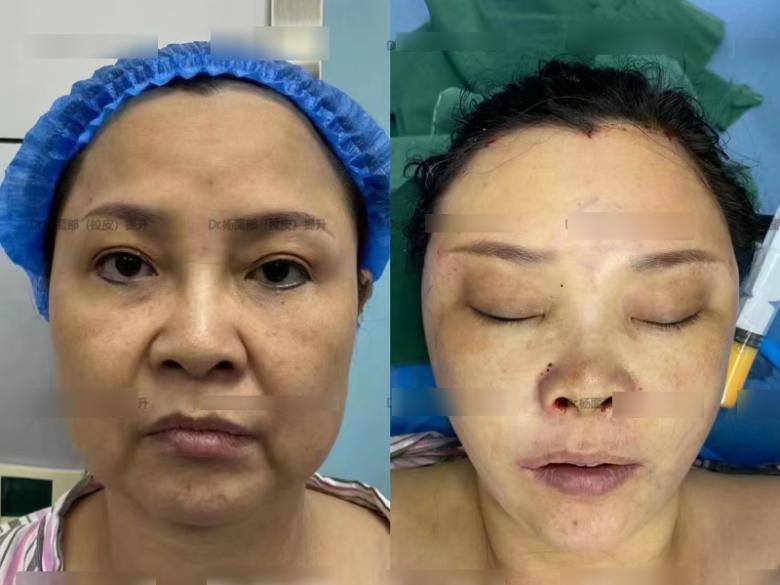 Người phụ nữ 50 tuổi ngại phẫu thuật, dùng sợi chỉ căng da, giờ phải rạch một đường lớn trên mặt, kết quả ra sao?-3