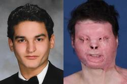 Người đầu tiên trên thế giới được phẫu thuật ghép mặt: Cuộc sống thay đổi thần kỳ sau 3 năm