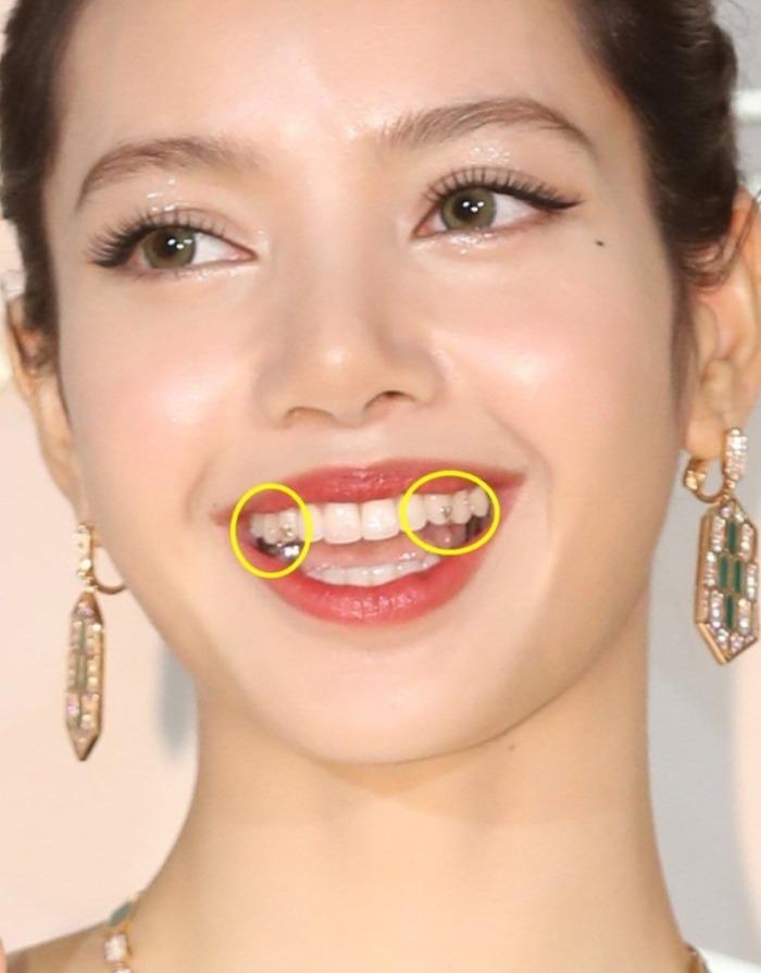 Trend răng đính đá được Lisa và loạt idol mê mẩn dạo này bỗng gây tranh cãi-2