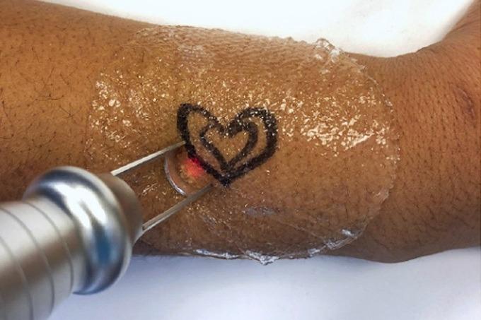 Tình yêu tan vỡ, cô gái cầu cứu bác sĩ xóa hình xăm nhạy cảm-2