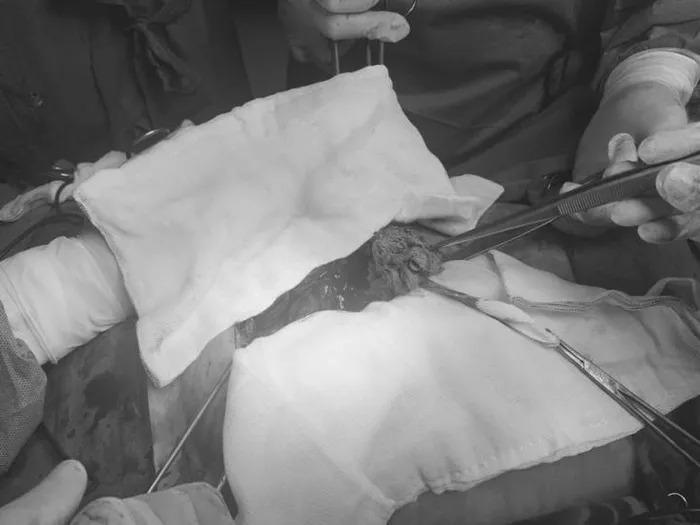 Phát hiện băng gạc bị bỏ quên 10 năm trong bụng bệnh nhân-2