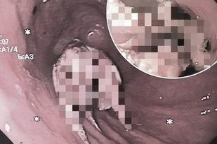 Người đàn ông suýt chết nghẹn vì nuốt chửng cả con bạch tuộc sống-1