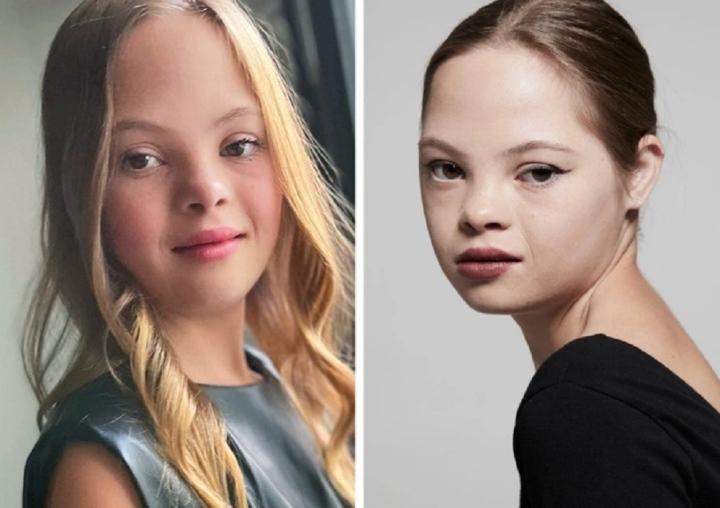 Cô bé mắc hội chứng Down bị bỏ rơi và hành trình trở thành ngôi sao Hollywood-3