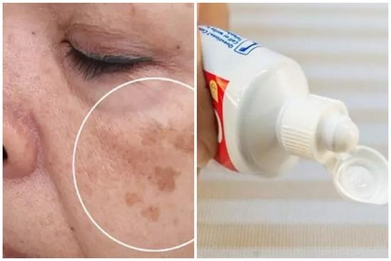 Sai lầm bôi kem đánh răng chữa đồi mồi, sự thật sau 50 có 4 cách giúp da đẹp như thời trẻ