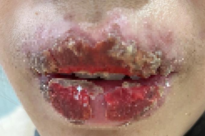 Hà Nội: Nữ sinh lớp 10 môi như tổ ong sau khi cùng chị đi xăm-1