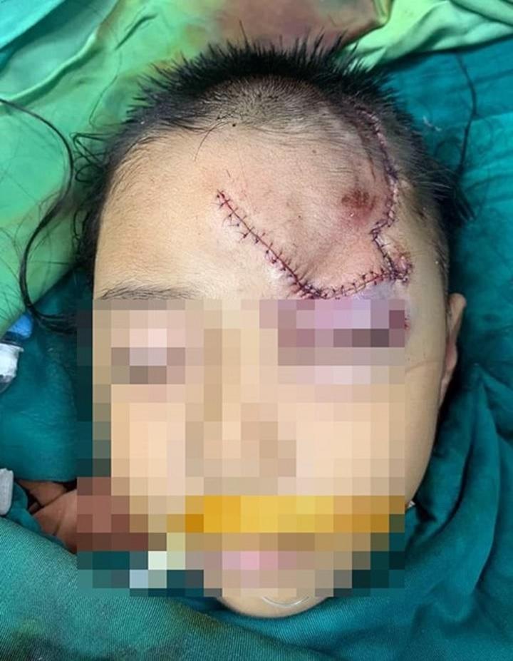 Ngồi chơi trước cửa, bé trai 5 tuổi ở Nghệ An bị chó lạ cào cắn vào mặt-1