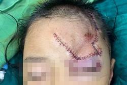Ngồi chơi trước cửa, bé trai 5 tuổi ở Nghệ An bị chó lạ cào cắn vào mặt