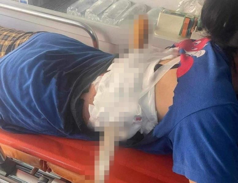 Người phụ nữ ở Hà Tĩnh bị chồng dùng dao nhọn phóng xuyên lưng-1