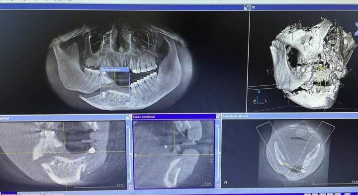 Mất toàn bộ răng cửa vì cúi người vào thang máy đang sửa để nhặt điện thoại-1