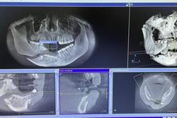 Mất toàn bộ răng cửa vì cúi người vào thang máy đang sửa để nhặt điện thoại