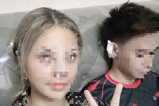 Bác sĩ nói gì về thông tin cô gái nâng mũi bằng sụn tai của bạn trai?