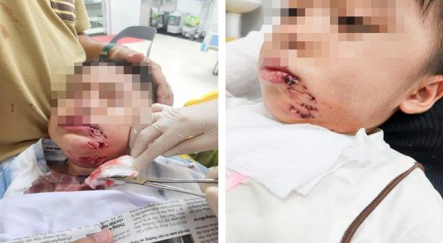 Đi du lịch cùng gia đình, cháu bé 3 tuổi bị chó cắn phải khâu 32 mũi-2