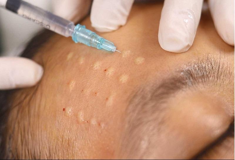 Bác sĩ da liễu lý giải vì sao tiêm meso gây sốt trong thẩm mỹ nội khoa-2