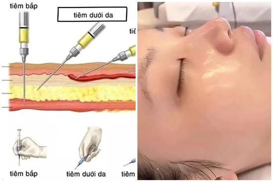 Bác sĩ da liễu lý giải vì sao tiêm meso 'gây sốt' trong thẩm mỹ nội khoa