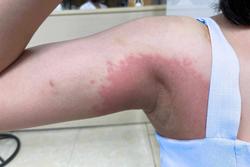 Hà Nội: Cô gái sốc nặng vì nách đổi màu sau khi lột da tại spa