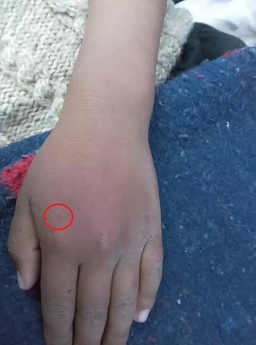 Bé trai 8 tuổi cho nhện Góa Phụ Đen cắn vì muốn thành Người Nhện, tình trạng ra sao?-2