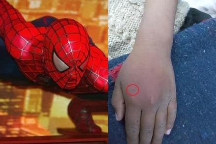 Bé trai 8 tuổi cho nhện Góa Phụ Đen cắn vì muốn thành Người Nhện, tình trạng ra sao?