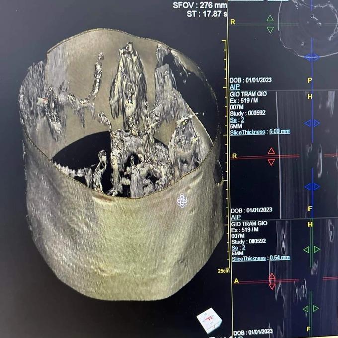 Xôn xao hình ảnh cây trầm hương được đưa vào phòng khám, chụp cắt lớp-3