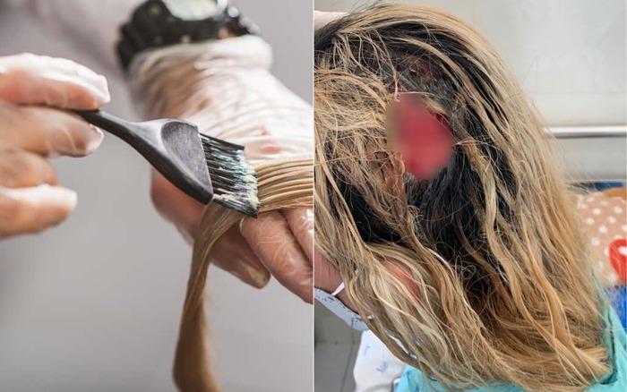 Làm gì để hạn chế tác hại không mong muốn khi hoại tử da đầu vì tẩy tóc?-1