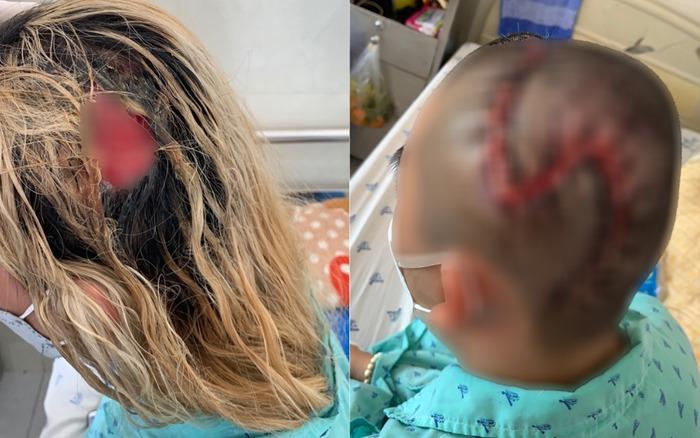 Làm gì để hạn chế tác hại không mong muốn khi hoại tử da đầu vì tẩy tóc?-3