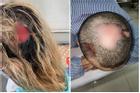 Làm gì để hạn chế tác hại không mong muốn khi hoại tử da đầu vì tẩy tóc?