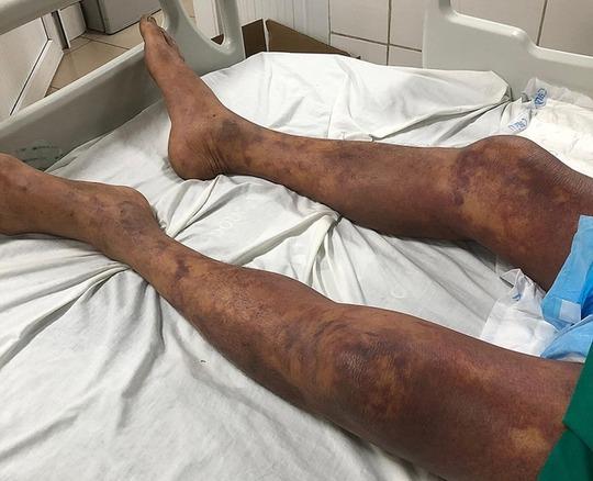 Người đàn ông tím đen cơ thể sau khi ăn thịt lợn ốm-1