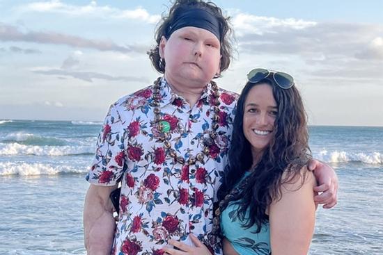 Nữ y tá bị gọi là ‘kẻ đào mỏ’ vì hẹn hò chàng trai biến dạng mặt