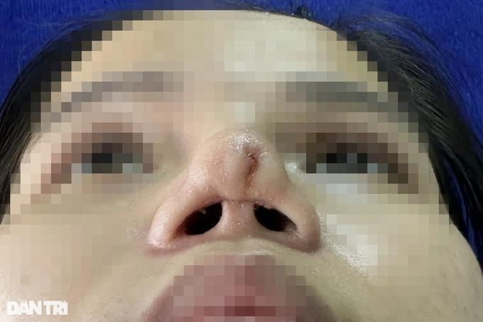 Đến spa biến Thị Nở thành công chúa, cô gái ở TPHCM tai biến nặng-1