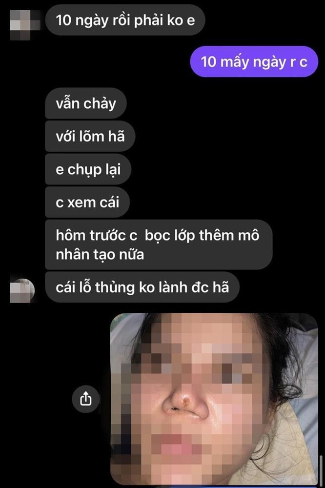 Đến spa biến Thị Nở thành công chúa, cô gái ở TPHCM tai biến nặng-2