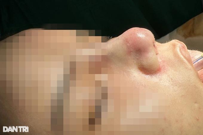 Đến spa biến Thị Nở thành công chúa, cô gái ở TPHCM tai biến nặng-4