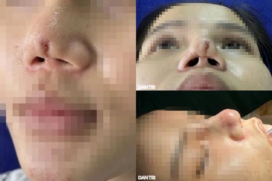 Đến spa 'biến Thị Nở thành công chúa', cô gái ở TPHCM tai biến nặng