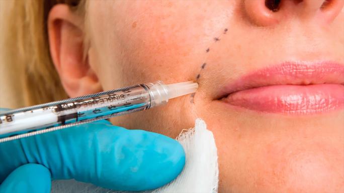 Những vùng da nào không được tiêm filler?-1