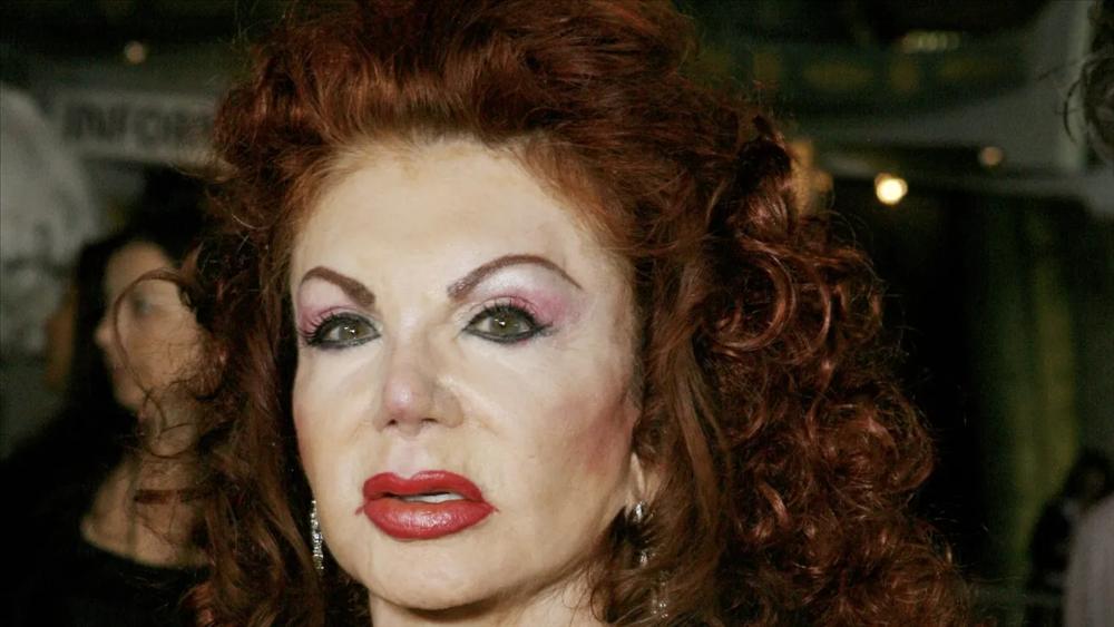 Những ca phẫu thuật thẩm mỹ thất bại của showbiz: Từ nổi tiếng đến biểu tượng thảm họa-4