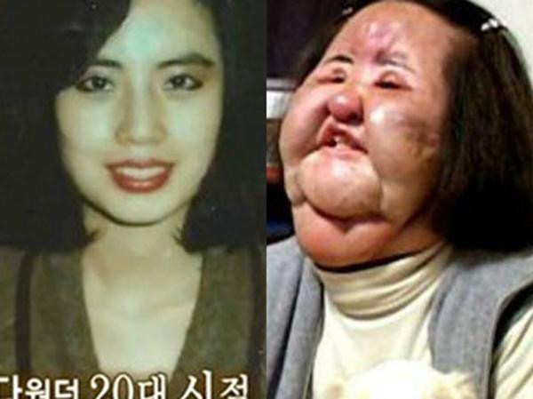 Những ca phẫu thuật thẩm mỹ thất bại của showbiz: Từ nổi tiếng đến biểu tượng thảm họa-8