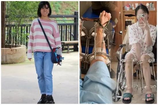 Cô gái Hà Nội chi 230 triệu đồng kéo dài chân thêm 7cm