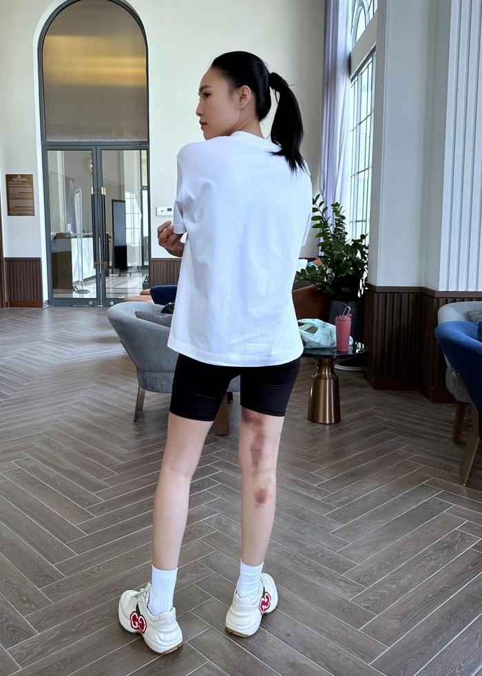 Ninh Dương Lan Ngọc khiến khán giả lo lắng khi lộ vết bầm tím lớn ở chân-1