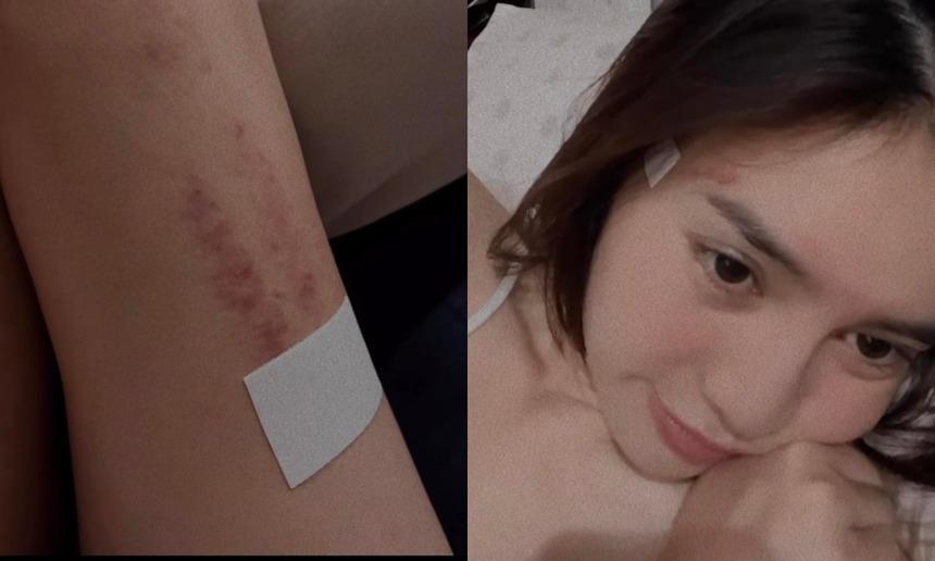 Ninh Dương Lan Ngọc khiến khán giả lo lắng khi lộ vết bầm tím lớn ở chân-3