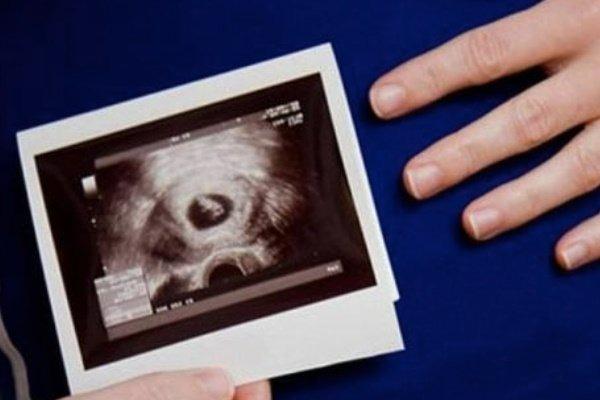 Bất ngờ khi bác sĩ báo có thai ở lách, thế giới chỉ mới phát hiện 39 ca-1