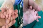 Hy hữu bé gái sinh ra khác thường với 24 ngón tay, chân