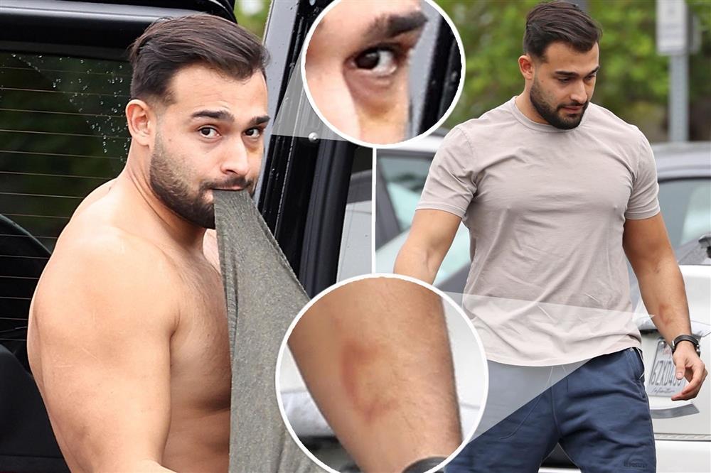 Chồng của Britney bị... đấm tím mắt khi đang nằm ngủ bên vợ?-5